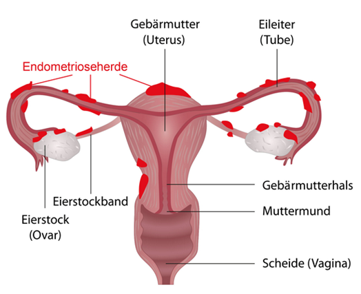 Endometriose Schaubild